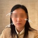 청담 튠페이스 &amp; 튠아이즈 리프팅 시술 가격, 효과 후기