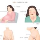 쿠싱증후군 원인 증상 진단 치료 이미지