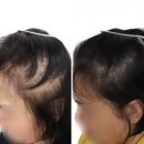 리젠셀의원 | 인천 두피smp 잘하는 곳 어버이날 아빠선물 두피문신 내돈내산