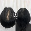 촘촘 스칼프 이미지