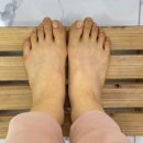 레푸스 구월점 내성발톱 무좀발톱 발각질 문제성발 이미지