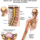 Cervical Disc 이미지