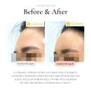 비포성형외과의원 | 무턱 필러, 턱 끝 필러, 이마 필러, 다크필러, 눈 밑 필러, 볼 필러 비포 애프터 후기 사진 / 청주성형외과