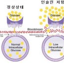 고혈압에 대한 원인과 치료 이미지