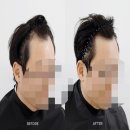 마곡두피｜마곡SMP 라이모플러스-두피커버, 정수리 M자커버