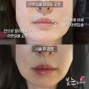 대영피부과의원 | 말린 입술 필러, 입술 말림증 개선하려면 반드시 알아야할 2가지 (+사진 첨부)