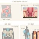 크론병 증상 원인 치료 식습관 완치 이미지