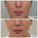서면Q외과동물병원 | 서면 팔자 실리프팅 2주 후기 | 남자친구의 ㅅ라인 팔자주름 고민해결! 통증 및 변화 리얼 후기