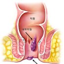 치핵 종류 내치핵 외치핵 혼합치핵 원인 증세 검사 낫는법 1기 2기 3기 4기 이미지