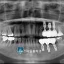 스마일홍치과의원 네이버블로그