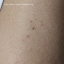 송헌일토닥토닥정신건강의학과의원 | 20대 팔뚝 대상포진 후기, 증상, 운동 언제부터? 🥹