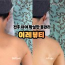 4196 | 당진 체형관리 에스테틱 이레뷰티 | 온열뱀부 등관리 솔직후기