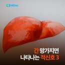 간이 안 좋을 때 나타나는 위험 증상 3 이미지