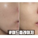 카프리 | 경기 평택 고덕 피부과 여드름 피지선 파괴 카프리 레이저 시술 후기