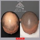 31140-8-49-2 | 홍대·영등포 두피디자인 후기｜49세 삭발 탈모, 다 돌아보고 선택한 곳 (1년 솔직 후기)