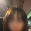 모발이식1) 여자 헤어라인 모발이식 내돈내산 리얼후기 2800모+@ 수술 당일부터 이주일차까지