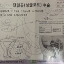 난임기록 번외편2 | 시험관시술 중 자궁근종 | 자궁근종 수술 비용 | 시온여성병원 | 이현철 과장님