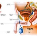 전립선 비대증과 전립선암 이미지