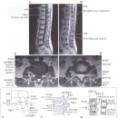 MRI 보는법 1.- Lumbar Spine 이미지