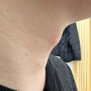 오산 쥐젖제거 잡티제거 아네스뷰티 추천