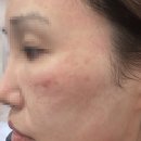 리젠셀의원 | 피부과재생크림 EGF 화장품 더마솔루션 시술 후 실 사용 후기