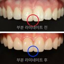 생활 도자기(야간) | 깨진 앞니 이것 때문에 전체를 깎아야 하나요? 구월동야간진료