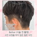 [두피채움: 남성 땜빵문신] 이발 했을 때 드러나는 땜빵에 두피문신 시술