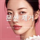 수지강한의원 | 신사역 피부과 레터링 문신 제거 후기 및 1회 시술 효과 분석 (가격/통증)