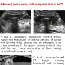 Advanced gastric cancer with malignant ulcer 이미지