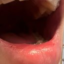 푸른치과의원 | 매복 사랑니 수면마취 압구정역 줌 구강악안면외과 치과의원 사랑니발치