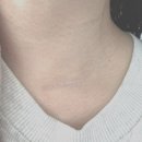 갑상선암 반절제 수술한지 2달 경과 후기(+흉터관리)