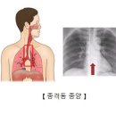 양성 종격동 종양[Benign mediastinal tumor종양혈액질환, 호흡기질환] 이미지