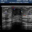 breast biopsy 이미지