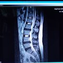 석호침법-요추 추간판탈출증- 치료 전후 MRI 영상 1례 이미지