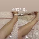 코끼리 다리 탈출 시켜준 라인닥터 압박밴드 후기