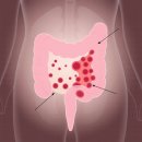 대장암 4기가 간으로 전이 간암 4기 판정 SOD 복용 기적의 후기-(주)리쏘드