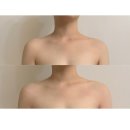 뷰티바비 | 세종 조치원 오송 | &#34;예비신부 데콜테 승모근 라인 관리&#34; 바비뷰티 라인이 확 달라진 솔직후기