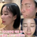 생성 | 미추홀구 피부과 모공 피코프락셀 후기 | 통증, 붓기, 효과, 다운타임 (내돈내산)