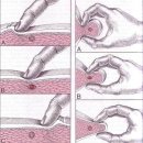 트리거포인트(trigger point: 통증유발점)| 이미지