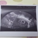 제일산부인과의원 | 심현남 동탄제일산부인과 난임검사 후기 &amp; 자연 임신 확인 (+ 임신 사전건강관리 보건소 지원)