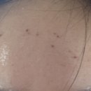 미앤영의원 | [ 독산동 미앤영 피부과 ] 달마시안급 점박이 갱생 점 빼기