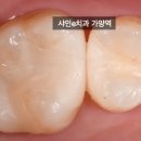 진리치과의원 | 치과의사들도 인정하는 이맥스 인레이, 막상 잘 안 하는 이유 (보철과 전문의의 속사정)