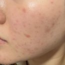 세일의원 | [내돈내산] 모즈의원 청담 여드름 관리 | 시술 가격 | 아쿠아필&amp;압출 3회차 후기 | 메이크프렘 클렌징...