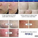 직장인 여드름/ 홍조 /파이토신 재생크림 완벽 가이드 | 스트레스 트러블 완벽 해결