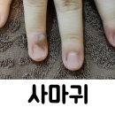 둔산튼튼한의원 | 대전 사마귀 피부과 질환 재발이 걱정되시죠