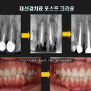 공주 미소담 치과 재신경치료 잇몸성형 후 전치부 심미 보철 이미지