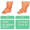 대한림프부종학회 이미지