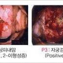 초기에는 별다른 자각 증상이 없어 치료시기를 놓치는 일이 흔해../자궁경부암 예방과 치료/송파 연산부인과 이미지