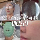 청라 매끄러에서 내돈내산 모공관리 두 번째 받은 후기
