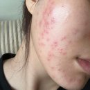 (주)에스틴 | 급성 피부염 + 여드름｜피부과 처방으로 작살난 피부, 알레르기 검사 가격/후기